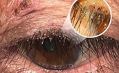Phát hiện ổ rận mu bám dày trên mí mắt người phụ nữ