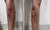 Cẳng chân người phụ nữ 29 tuổi biến dạng vì tiêm filler để làm... thẳng chân tại nhà