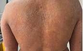 Dùng sai thuốc, nấm da lan toàn thân, ngứa dữ dội