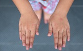 Các cấp độ bệnh tay chân miệng và dấu hiệu cảnh báo