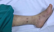 Bé 2 tuổi tử vong do não mô cầu thể tối cấp tại TPHCM