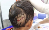 Bé 4 tuổi bị chó nhà cắn, nhiều vết thương nặng ở đầu và tay