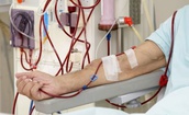 Nhiều bệnh nhân hồi sức nguy cơ suy thận, lọc máu liên tục cần làm sớm, không chờ 'giai đoạn muộn'