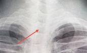 Sau ăn cá người đàn ông 46 tuổi bị mắc lưỡi câu sâu trong thực quản