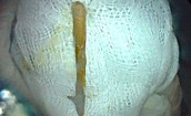 Đi cấp cứu vì tiêu chảy ra máu, phát hiện dị vật dài 3cm đâm thủng đại tràng