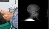 Nam thanh niên đi bắn cá bị mũi tên bật ngược đâm xuyên sâu 15cm vào vùng mặt