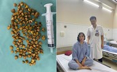 Bác sĩ lấy ra hàng trăm viên sỏi trong túi mật của nữ bệnh nhân 39 tuổi