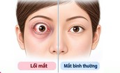 Mắt lồi, mất thị lực do khối u nằm sâu sau nhãn cầu
