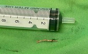 Mắc xương cá, người đàn ông phải cắt bỏ tuyến dưới hàm