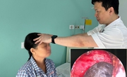 Phẫu thuật th&#224;nh c&#244;ng &#39;h&#242;n bi&#39; nấm trong xoang bướm