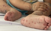 TP. Hồ Ch&#237; Minh: B&#233; trai 5 tuổi tử vong nghi mắc tay ch&#226;n miệng, những lưu &#253; đặc biệt với cha mẹ