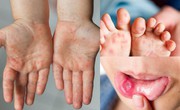 Ghi nhận ca mắc tay ch&#226;n miệng ở Nam Trung Bộ v&#224; T&#226;y Nguy&#234;n, khẩn trương c&#225;c biện ph&#225;p ph&#242;ng bệnh