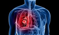 T&#236;nh trạng vi&#234;m c&#243; thể g&#226;y khởi ph&#225;t ung thư phổi ở giai đoạn sớm