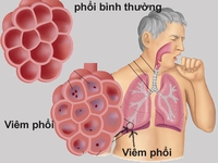 8 dấu hiệu của bệnh viêm phổi bạn không nên bỏ qua