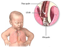 Ðể dị tật tiêu hóa không đe dọa sự sống của trẻ