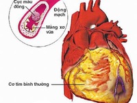 Phòng ngừa bệnh động mạch vành