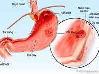 Viêm loét dạ dày