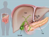 Điều trị viêm tụy cấp do tăng mỡ máu