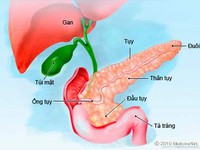 Phòng và điều trị polyp cholesterol