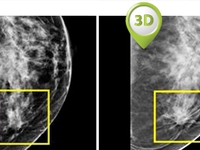 Phát hiện ung thư vú tốt nhất bằng cách chụp tia X-quang 3D