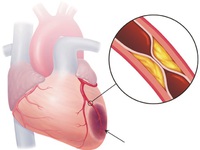 Nguyên nhân nào gây ra bệnh động mạch vành?