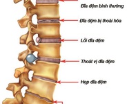 Bệnh gai cột sống và biến chứng