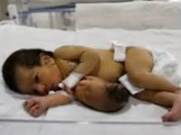 Bé sơ sinh có thêm đầu mọc ra từ bụng