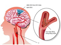 Thiếu máu não – Không nên chủ quan