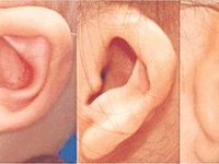 Dị tật tai nhỏ