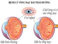 Biến chứng mắt do đái tháo đường