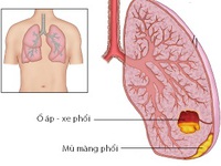 Ðể không bị áp-xe phổi