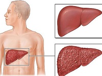 Các thuốc gây độc cho gan