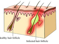 Thuốc trị bệnh viêm nang lông