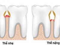 Chớ xem thường bệnh viêm lợi