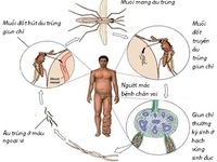 Khó phát hiện bệnh giun chỉ bạch huyết - Vì sao?