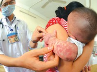Phát hiện ổ dịch sốt phát ban nghi sởi tại Nghệ An