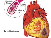 Xơ vữa động mạch: Nguyên nhân chính gây đột quỵ