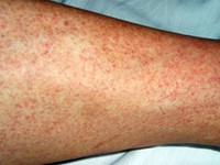 Sắp có vaccin ngăn ngừa sốt xuất huyết