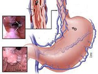 Phòng ngừa giãn tĩnh mạch thực quản ở người bệnh gan