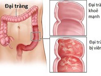 Nguy cơ gây viêm loét đại tràng