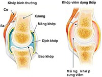 Giảm đau khớp tuỳ tiện: Hậu quả khó lường!