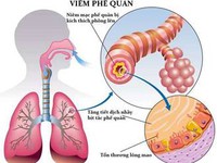 Nắng nóng - Làm gì để không mắc bệnh?