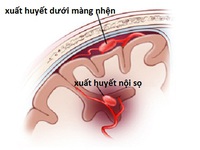 Bạn biết gì về xuất huyết mạch não dạng bột?