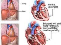 Khi buồng tim bị giãn nở