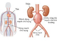 Vỡ động mạch do vi khuẩn tấn công