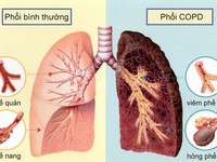 Ðể bệnh phổi tắc nghẽn mạn tính không trở nặng