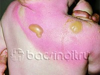 Cách đơn giản sơ cứu làn da cháy nắng