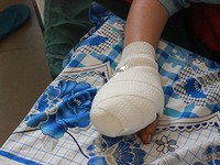 Một phụ nữ bị máy xay thịt nghiền nát bốn ngón tay