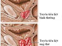 Thuốc điều trị xuất tinh ra máu