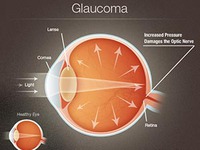 Nhận biết Glaucoma sớm để tránh mù lòa